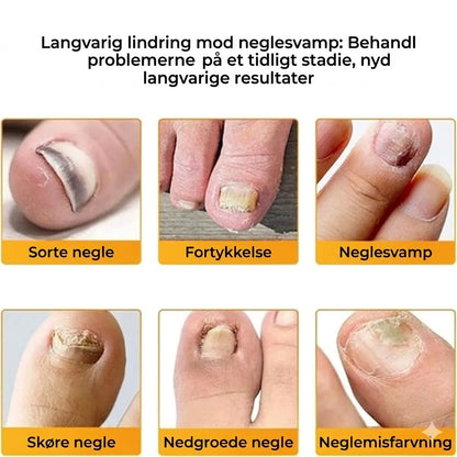 FungalPatch - Antibakterielt og svampedræbende plaster samt neglepleje-pakke